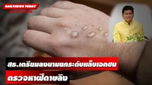 สธ.เตรียมลงนามยกระดับแล็บเอกชน ตรวจหาฝีดาษลิง | DAILYNEWS TODAY 27/07/65