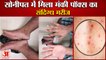 Patient of Monkey Pox Found In Sonipat Of Haryana|सोनीपत में मिला मंकीपॉक्स का संदिग्ध मरीज