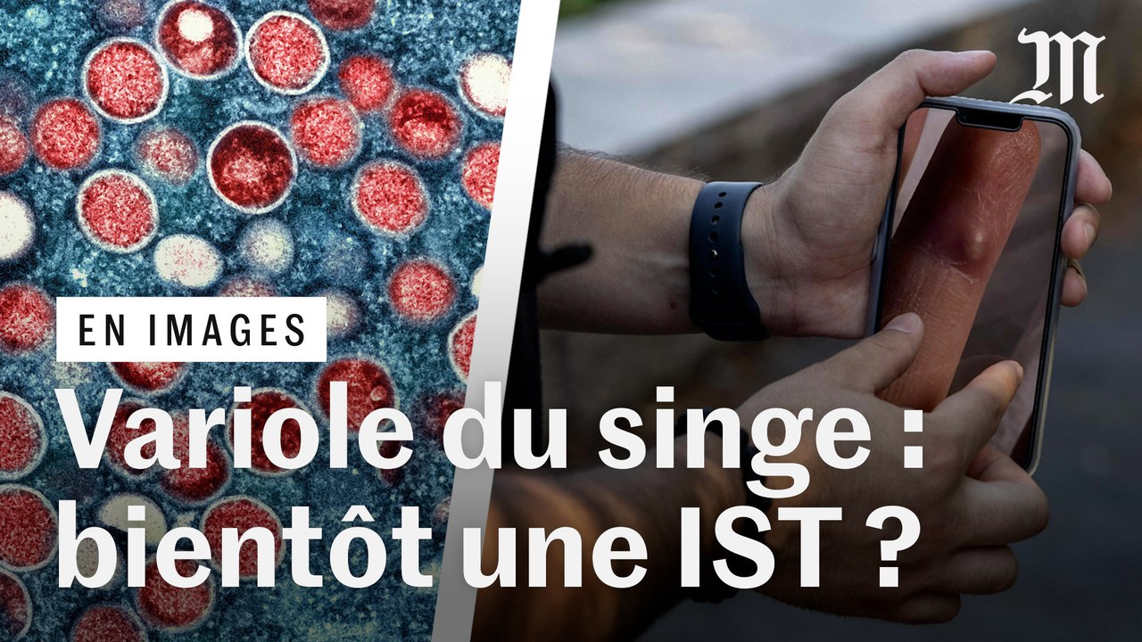 Variole du singe : comment les rapports sexuels entre hommes favorisent-ils la transmission ?