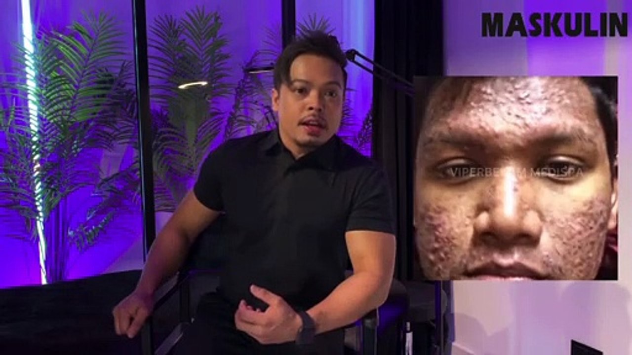 Xpert Maskulin : Berbekam Boleh Kurangkan Jerawat?