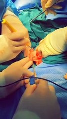 توثيق الخطوات الأخيرة لفصل التوأم اليمني "مودة ورحمة"