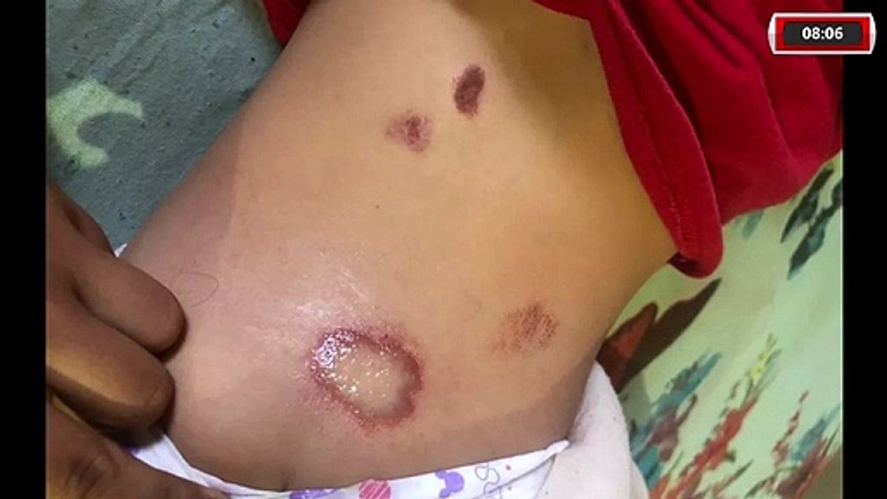 MENINA DE TRÊS ANOS ATROPELADA POR MOTORISTA EMBRIAGADA EM VIRADOURO, PRECISOU PASSAR POR CIRURGIA