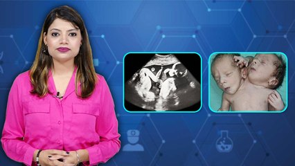 2 सिर 2 दिल वाला बच्चे क्यों पैदा होता है , Dicephalic parapagus क्या है | Boldsky*Health
