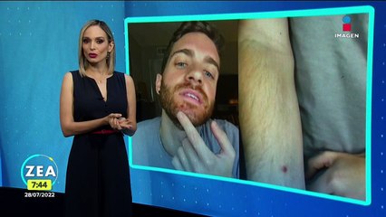 Joven con viruela del mono cuenta cómo fue víctima de los prejuicios