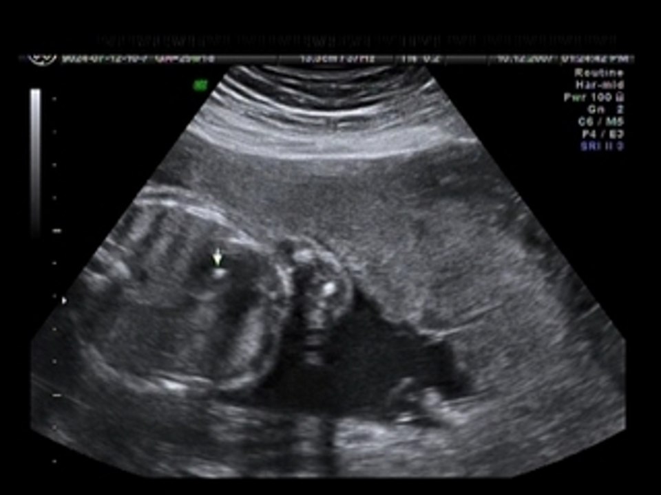 Echogenic intracardiac focus