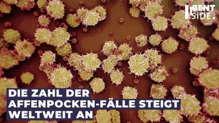 Affenpocken: Was du tun solltest, wenn du vermutest, dich angesteckt zu haben (1)