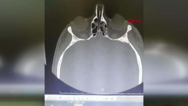 HASTA YAKINI, HEMŞİRENİN KAFATASI VE BURNUNU KIRDI