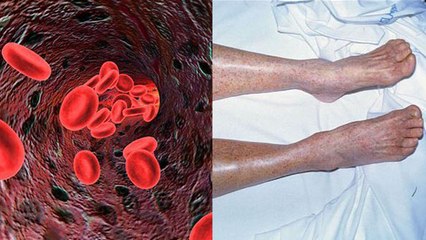 Blood Disorder Kya Hota Hai | ब्लड डिसऑर्डर क्या होता है | Boldsky *Health