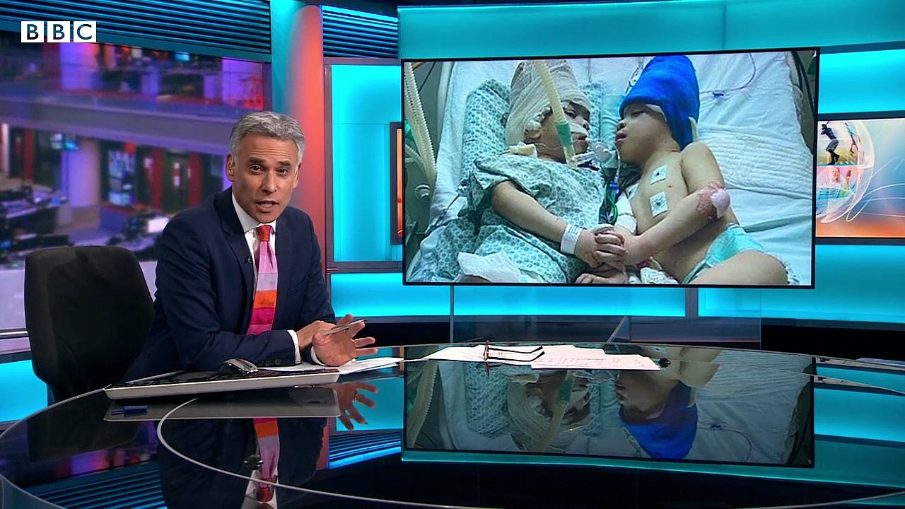 Conjoined twins separated with the help of virtual reality - BBC News