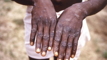 Download Video: California governor declares monkeypox state of emergency