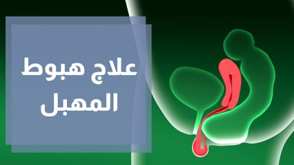 ما سبب هبوط المهبل.. وكيف يمكن علاجه؟