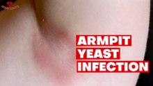 Armpit Yeast Infection (Candida) removal at home