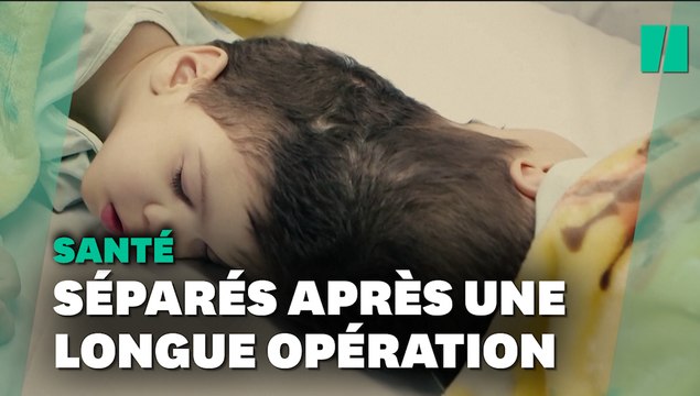 Des jumeaux siamois séparés à l’aide de la réalité virtuelle au Brésil