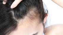 Geheimratsecken bei Frauen: SOS-Tipps bei Haarverlust