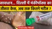 Monkeypox in Delhi: दिल्ली में मंकीपॉक्स का तीसरा केस मिला | Monkeypox Update | वनइंडिया हिंदी *News
