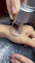 Retirer un tatouage au laser... impressionnant