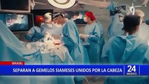 Brasil: operan exitosamente a gemelos siameses unidos por la cabeza