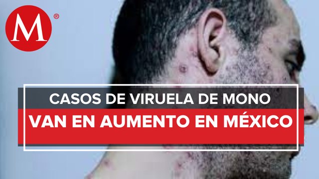 México suma 91 casos de viruela del mono: Ssa; sin reporte de muertes