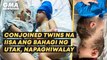 Conjoined twins na iisa ang bahagi ng utak, napaghiwalay | GMA News Feed