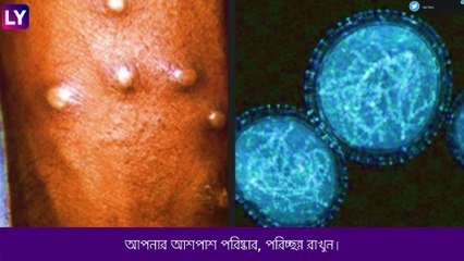 Monkeypox থেকে বাঁচতে গাইডলাইন কেন্দ্রের, দেখুন