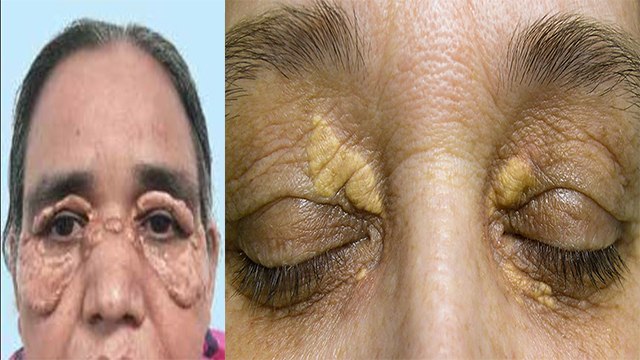 आंखों के ऊपर कोलेस्ट्रॉल क्यों जमा होता है | Aankhon ke Upar Cholesterol Jama Hona | Boldsky *Health