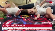 Yapışık ikizler sanal gerçeklikle ayrıldı!