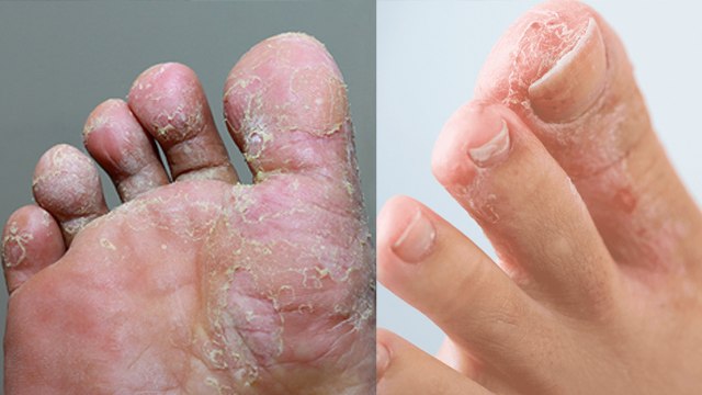 एथलीट फुट क्या है ? Athlete Foot Kya Hai | Athlete Foot Symptoms | Treatment | Boldsky *Health