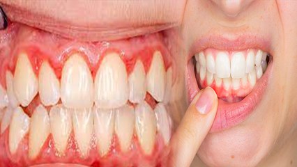 पायरिया से खराब हो रहें दातं को ठीक करने का घरेलू उपाय। Boldsky* Health