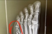 Coleen Rooney shares broken toe X-ray