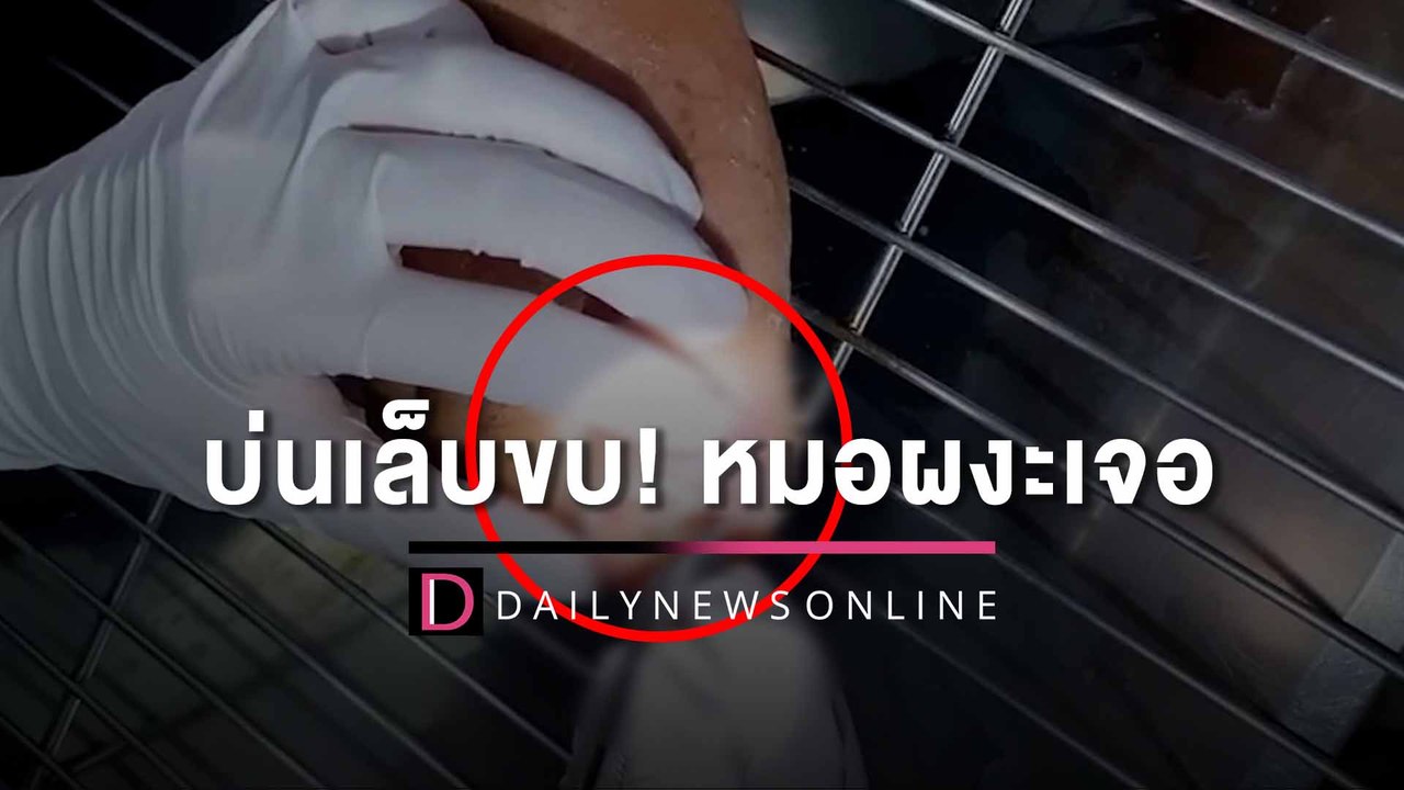 พ่อบ่นเล็บขบ พาหาหมอผงะเจอ หนอนชอนไชแผลนิ้วเท้า6ตัว | HOTSHOT เดลินิวส์ 04/08/65