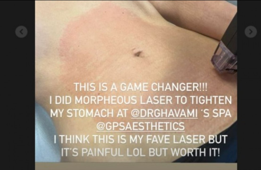 'This is a game changer!': Kim Kardashian shares results from stomach-tightening procedure