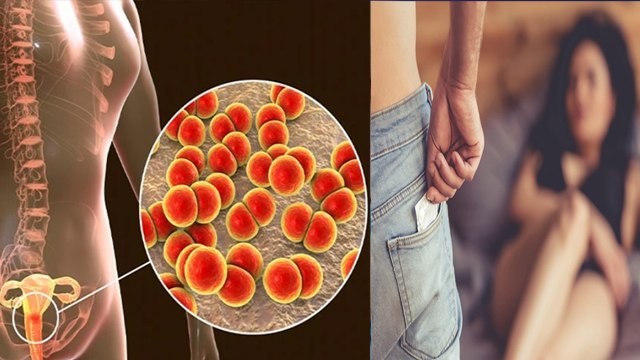 गोनोरिया रोग कैसे होता है | Gonorrhea Kya Hai | Gonorrhea Symptoms In Hindi | Boldsky *Health