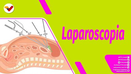 Buena Vibra | ¿Qué es una laparoscopia?