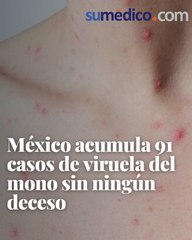 México acumula 91 casos de viruela del mono sin ningún deceso