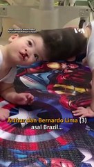 Bayi Kembar Siam Brasil Sukses Jalani Operasi Pemisahan