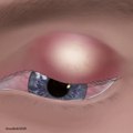 Satisfying, eye style treatment animation - eye pimple - tingle sound [ASMR]