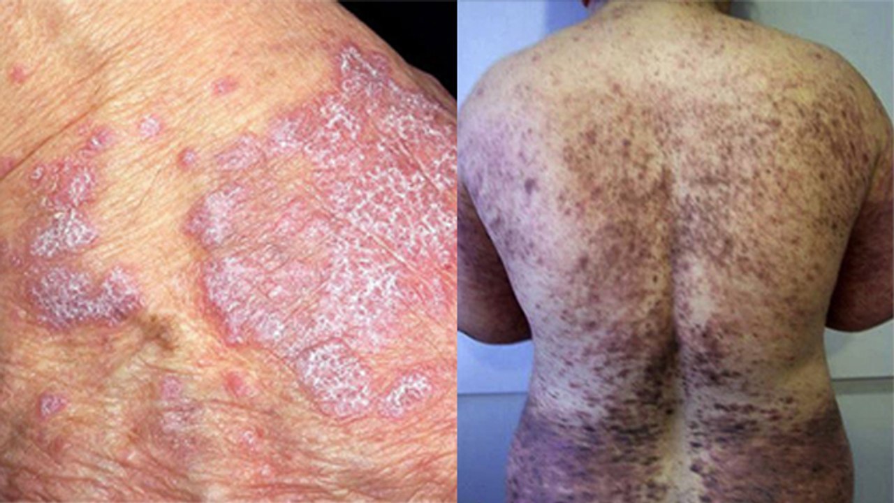 Lichen Planus Skin Disease क्या है ? जानें क्या है लाइकेन प्लेनस का Treatment | Boldsky *Health