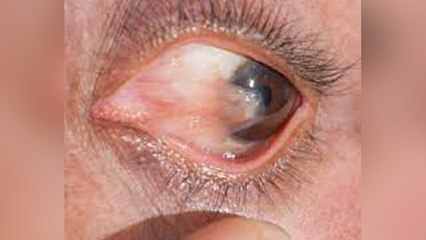 आंखों का जाला क्यों होता है । आंखों में जाला होने का कारण । Boldsky*Health