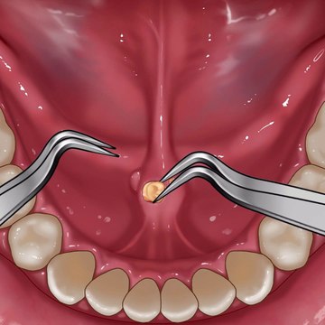 ASMR Salivary Gland Stones Removal Animation