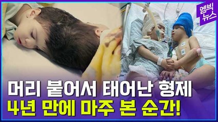 [엠빅뉴스] 33시간 수술 끝에 헤어진 두 아들 (feat.가상현실)
