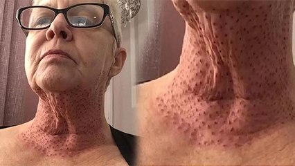Jayne Bowman neck skin Lizard जैसी क्यों, क्याें होते है लाल धब्बे । Boldsky *Health