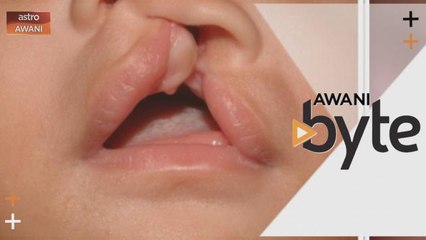 #AWANIByte: Sumbing bibir dan lelangit sebabkan masalah paru-paru
