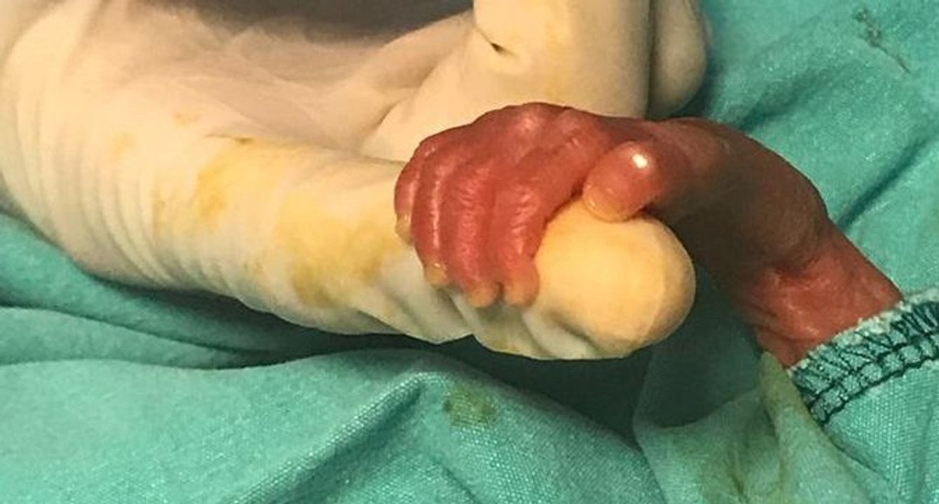 540 gramlık parmak bebek hayata tutundu