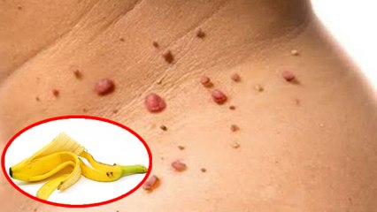 मस्से को जड़ से खत्म करेगा केले का छिलका बस इस तरह से करें इस्तेमाल । Boldsky* Health