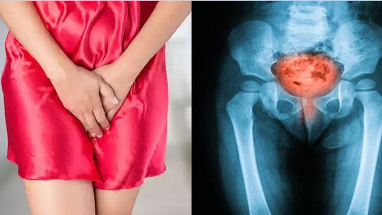 पेशाब में जलन खतरनाक सिस्टाइटिस बीमारी का संकेत, Cystitis Disease Symptoms | Bodsky *Health