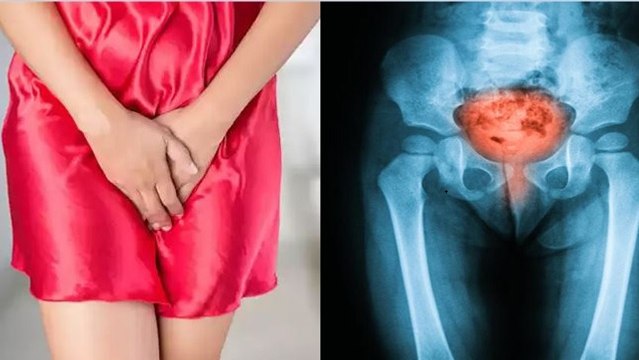 पेशाब में जलन खतरनाक सिस्टाइटिस बीमारी का संकेत, Cystitis Disease Symptoms | Bodsky *Health