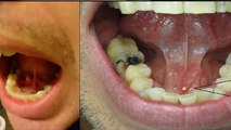 मुंह में पथरी क्यों होती है ? मुंह में सफेद दाग पथरी होने का लक्षण | Boldsky *Health