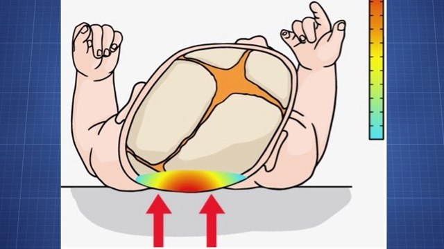bd-deformidades-en-craneo-de-bebes-por-mala-postura-170822