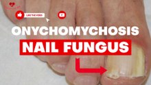 How to treat a Nail infection at home - Onychomycosis
