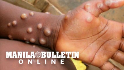 DOH confirms two more cases of monkeypox in PH